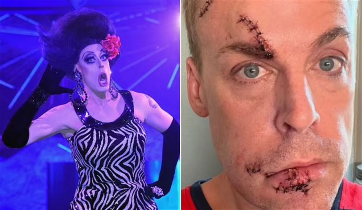 Rupaul’s Drag Race Legend Reveals Shocking Facial Injuries After Mystery Fall At Home